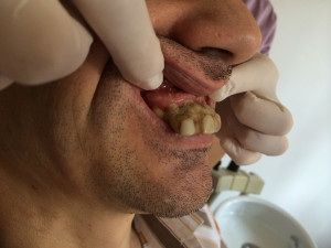 Situatia initiala - deformare faciala si ocluzala