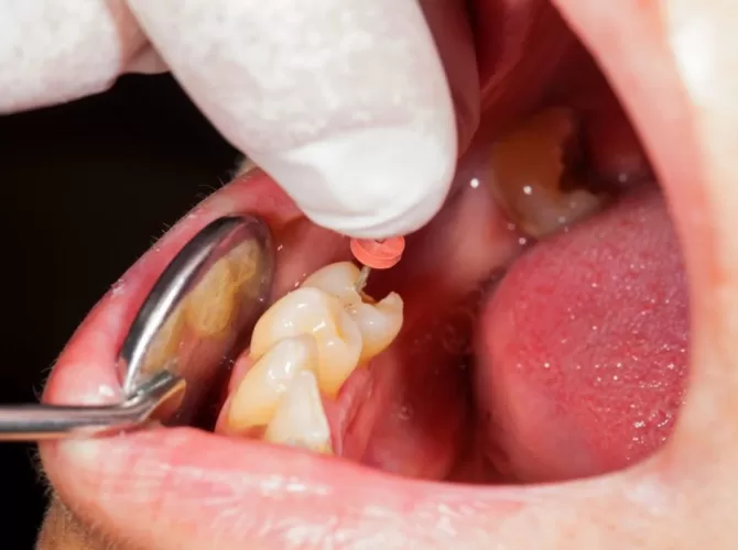 Endodontia-reatamentul pulpei dentare-cabinet stomatologic, coroana zirconiu