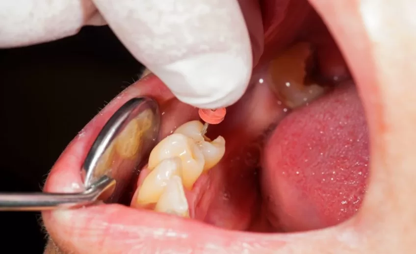 Endodontia-reatamentul pulpei dentare-cabinet stomatologic, coroana zirconiu