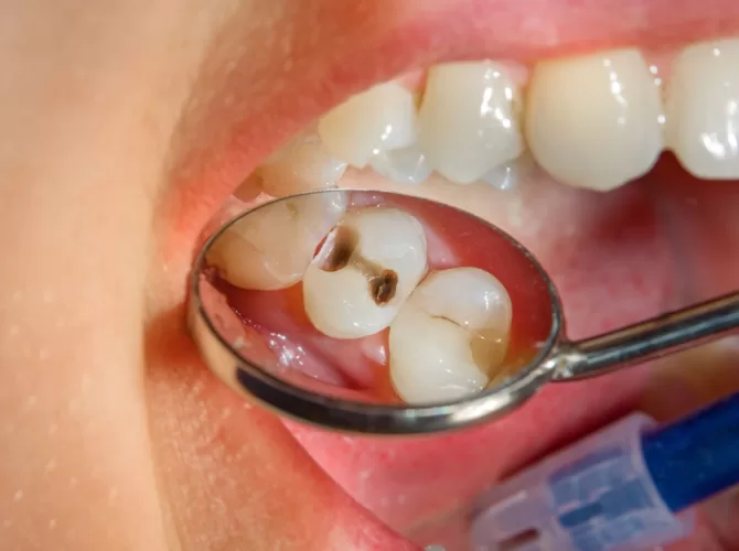 Odontoterapia (plombarea cariilor) - cabinet stomatologic, coroana zirconiu