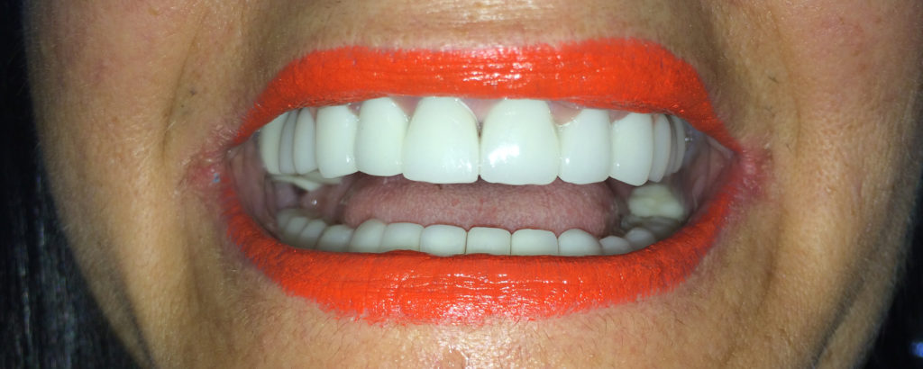 punte zirconiu - ceramica pe zirconiu - rezultatul final