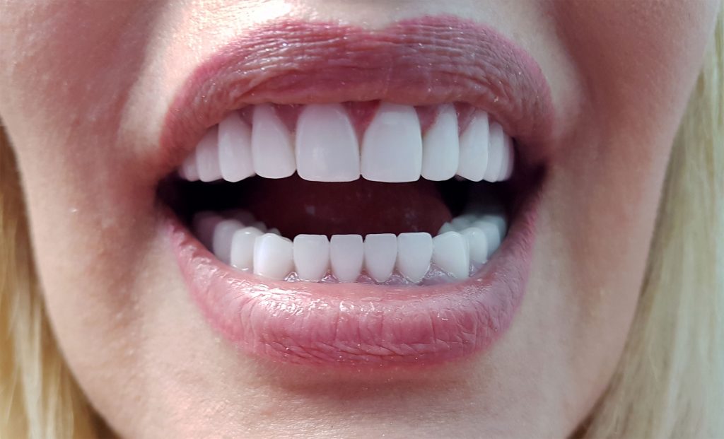 coroana zirconiu | punti totale pe zirconiu