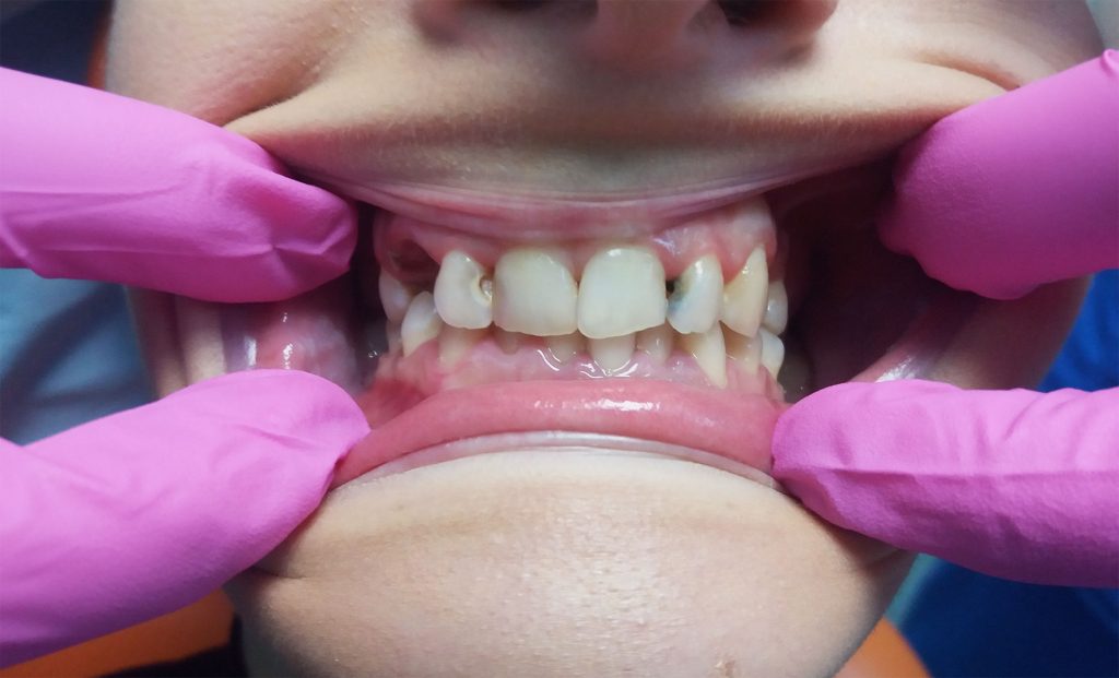 coroane ceramica pe zirconiu