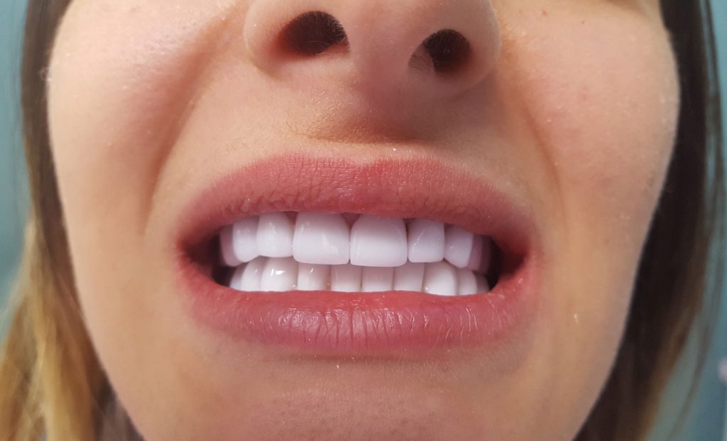Coroana zirconiu | coroane ceramica pe zirconiu pe implant situatie finala