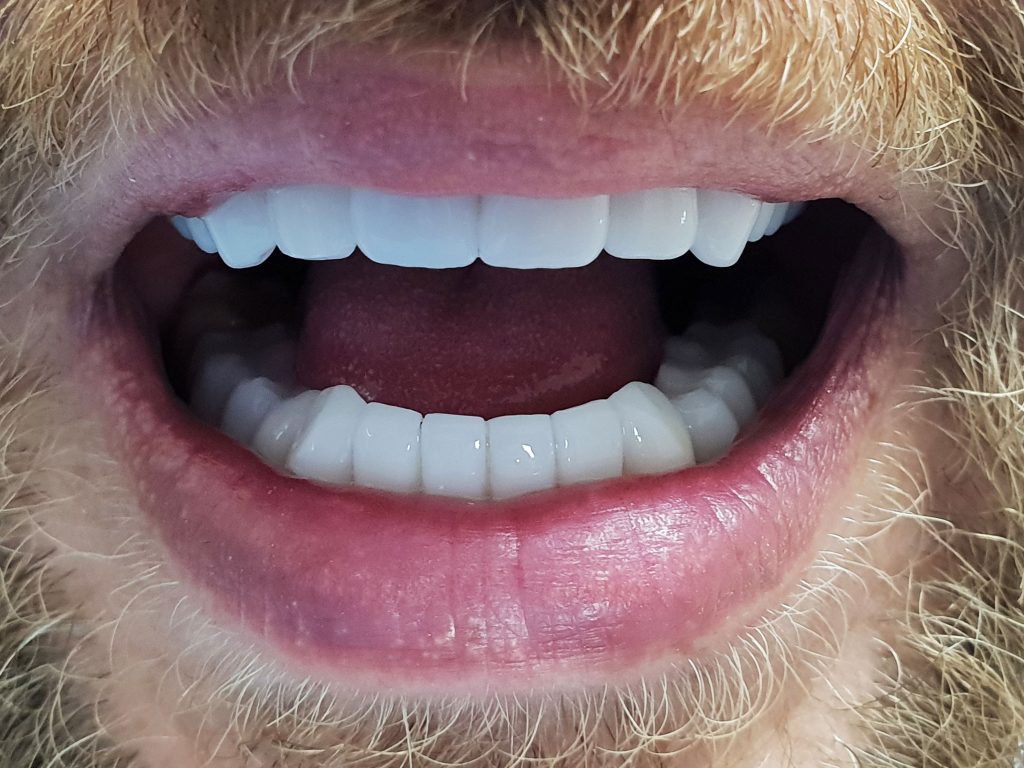 Coroane integral zirconiu