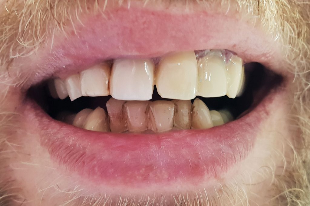 Coroane integral zirconiu multilayer - situatia initiala