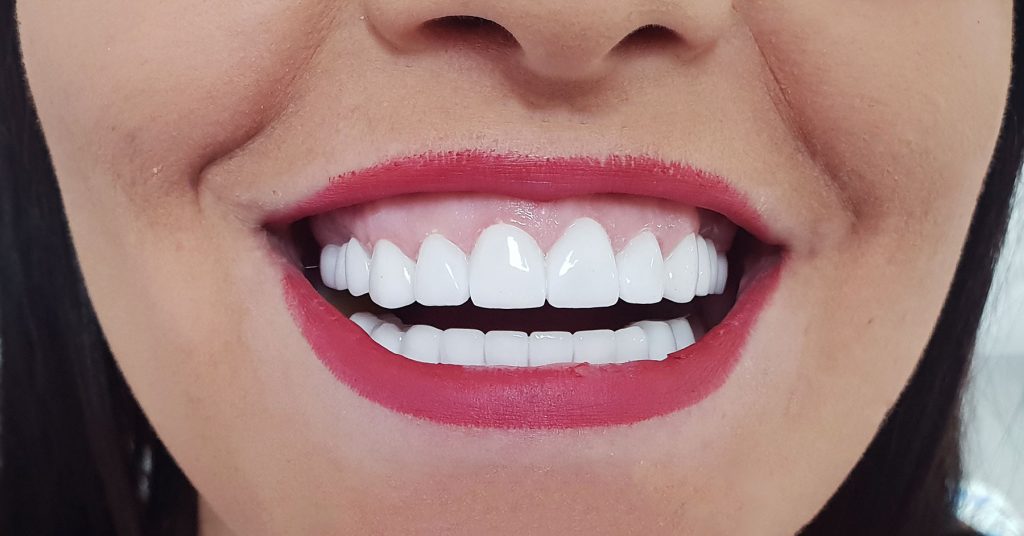 Coroane ceramica pe zirconiu