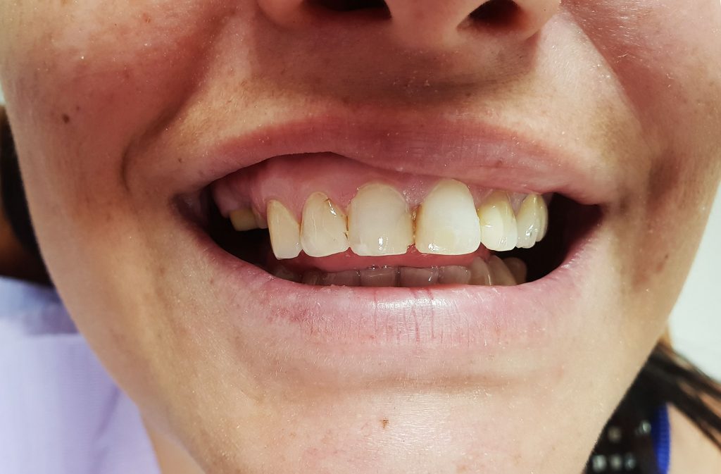 Coroane ceramica pe zirconiu-caz initial