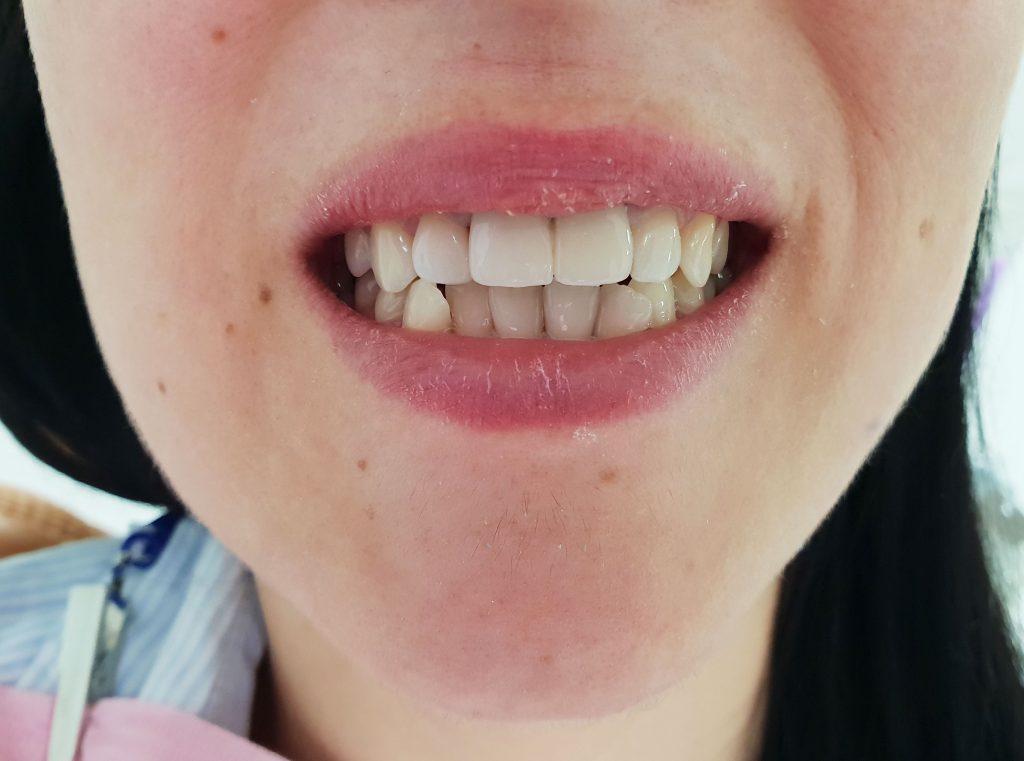 coroane individuale ceramica zirconiu