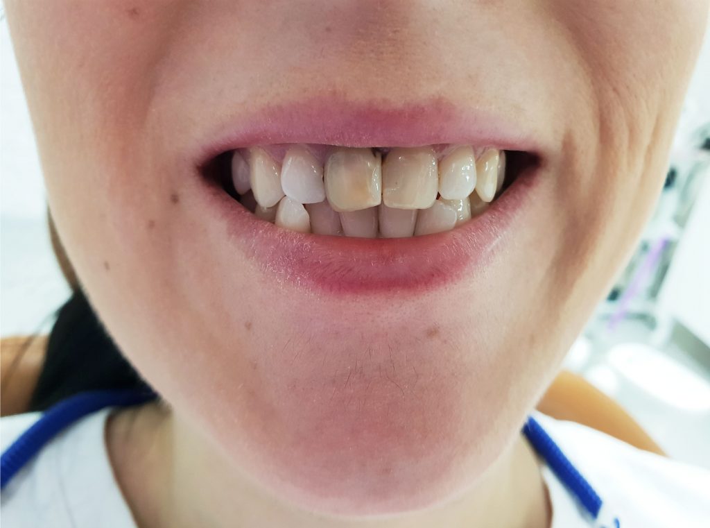 coroane individuale ceramica zirconiu-initial