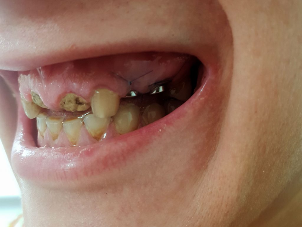 Punti totale ceramica pe zirconiu - situatie intermediara