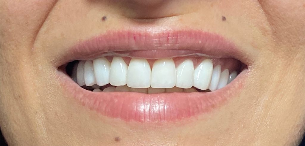 Coroane individuale ceramica pe zirconiu