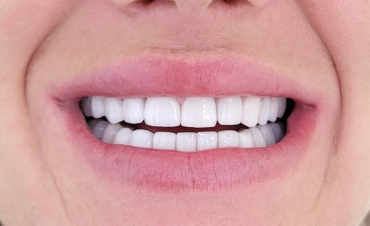 coroane individuale ceramica pe zirconiu