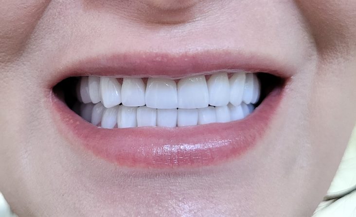 coroane individuale ceramica pe zirconiu