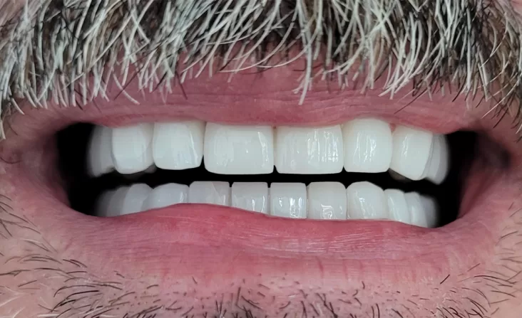 Coroane zirconiu multilayer, situatia finala