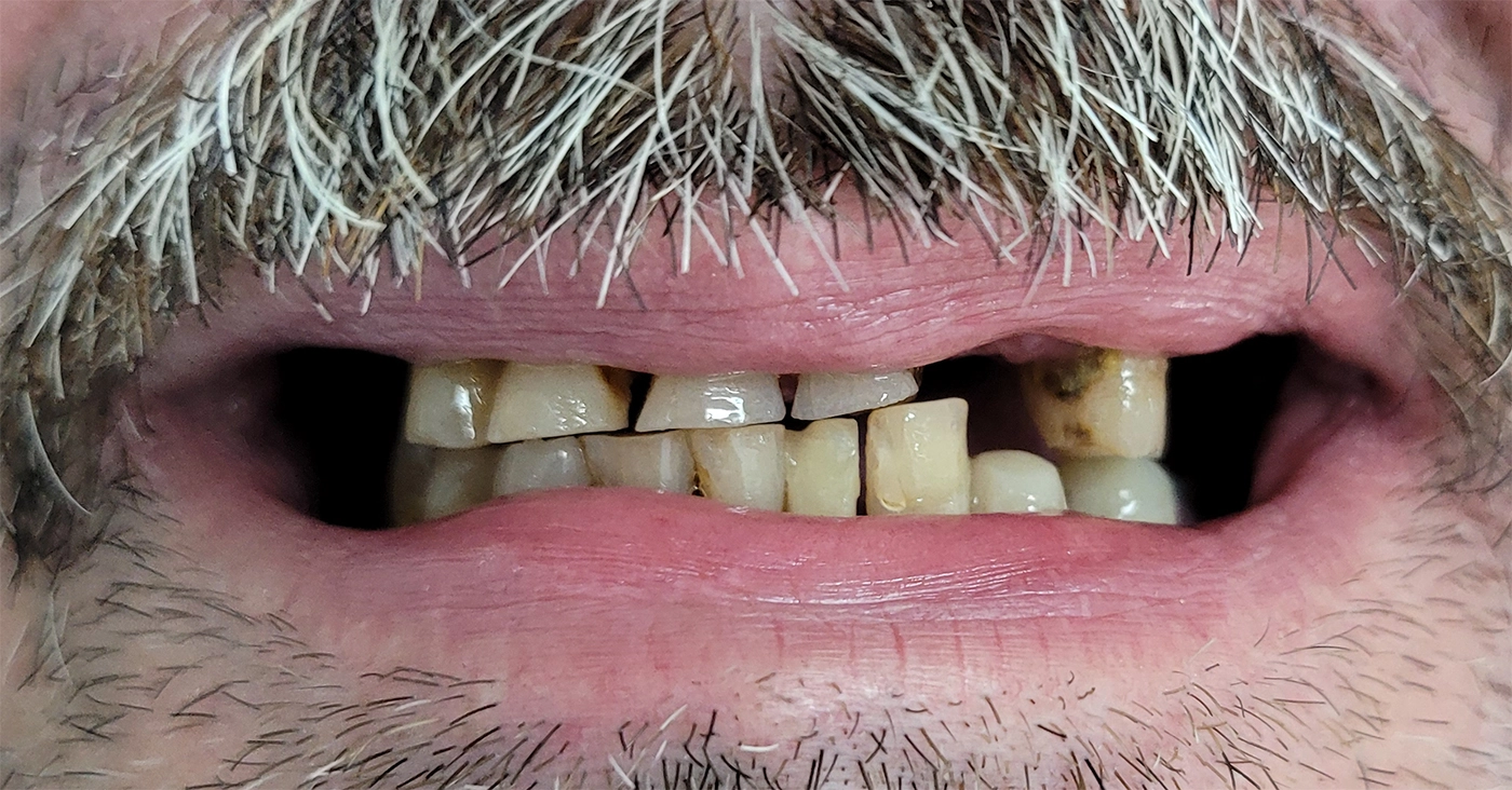 Coroana zirconiu - before